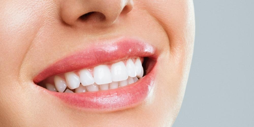 Diş Beyazlatma